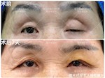 【学科强院】整形美容科成功开展巴南区首例额肌筋膜瓣转移术矫正重度上睑下垂